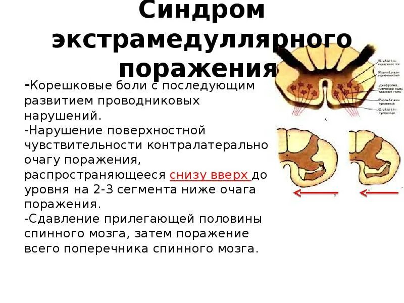 Корешковое поражение. Синдромы поражения спинного мозга. Синдром компрессии спинного мозга. Корешковые поражения спинного мозга. Синдром сдавления спинного мозга.