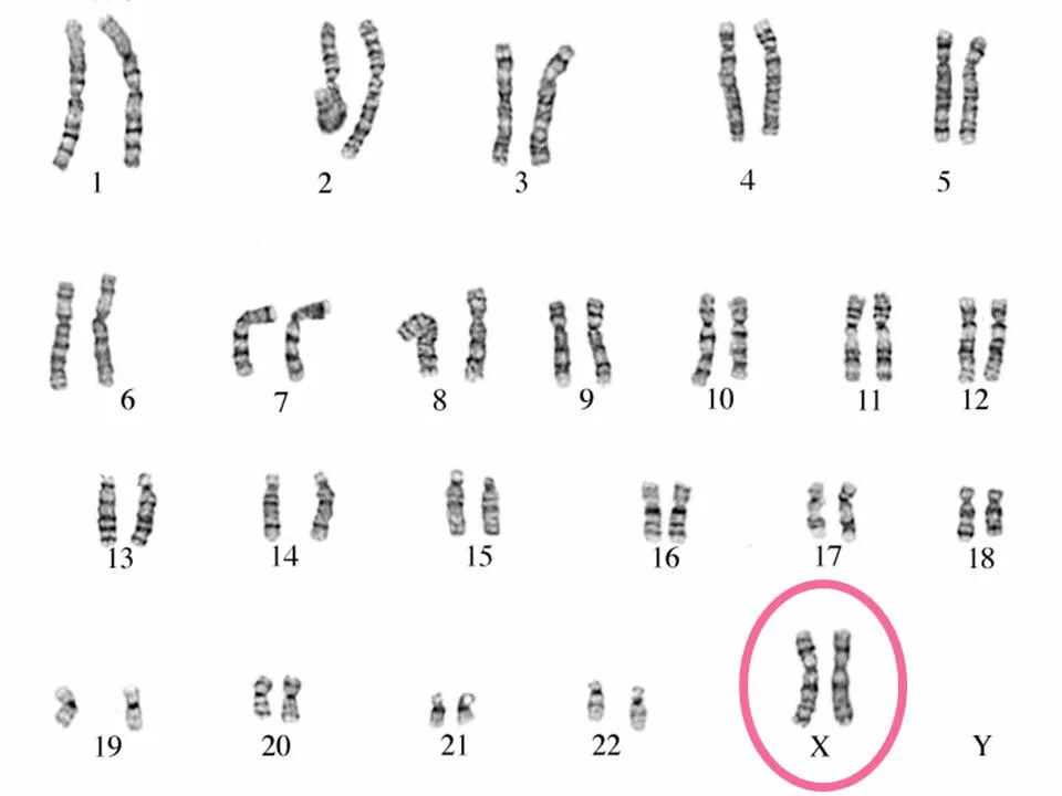 Хромосомы краба. Нормальный кариотип человека 46 хромосом. 46 ХХ нормальный женский кариотип. Хромосомная карта здорового человека. Кариотип 46 XX пол.