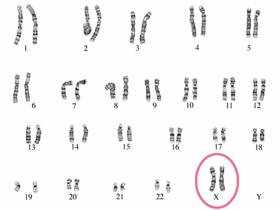 Хромосомы группы г. Нормальный кариотип человека 46 хромосом. 46 ХХ нормальный женский кариотип. Хромосомная карта здорового человека. Кариотип 46 XX пол.