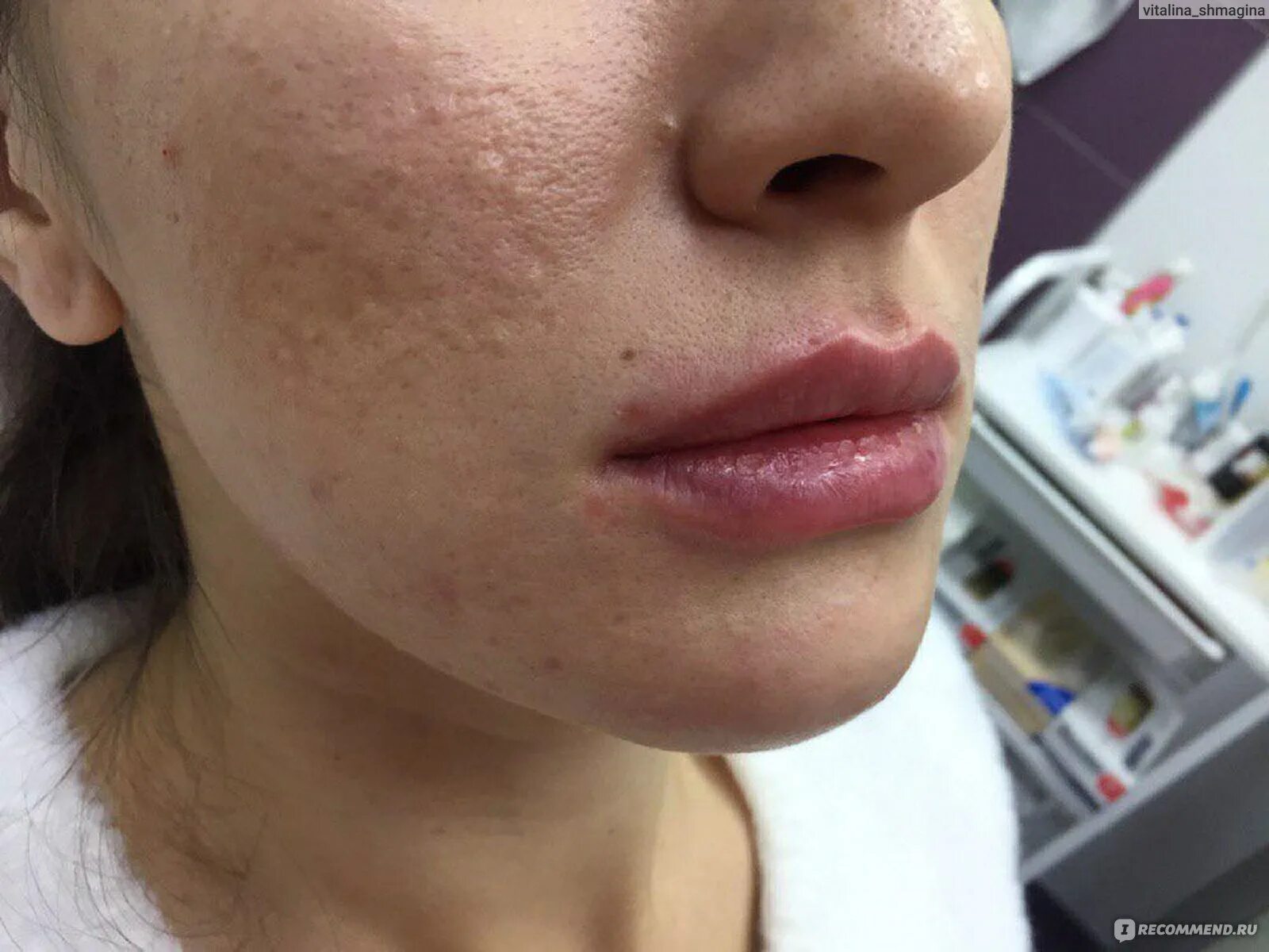 Гиалуроновая кислота Juvederm Ultra 3 - "Увеличение губ. Препарат Ювидерм." отзы