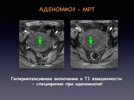 Мрт эндометрия