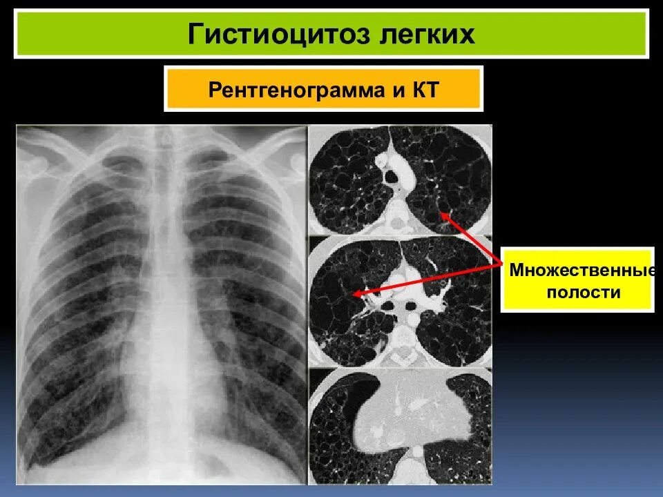 Гистиоцитоз легких. Лангергансоклеточный легочный гистиоцитоз кт. гистиоцитоз х кт легких. легочный гистиоцитоз.