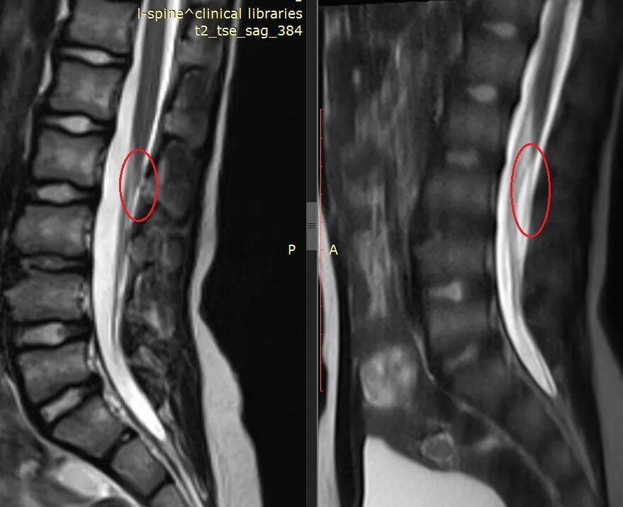 Спинальный дермальный синус. Липома терминальной нити спинного мозга.