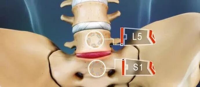 Диски l5-s1 в позвоночнике. Позвоночные диски l5-s1. Межпозвонковые диски l4-s1. Л5 с1 грыжа пояснично крестцового отдела.