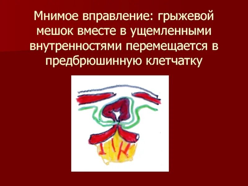 Мнимое вправление ущемленной грыжи. Самопроизвольное вправление грыжи. Осложнения грыж мнимое вправление грыжи. Осложнения грыж презентация.