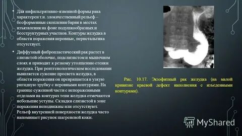 Инфильтрация желудка