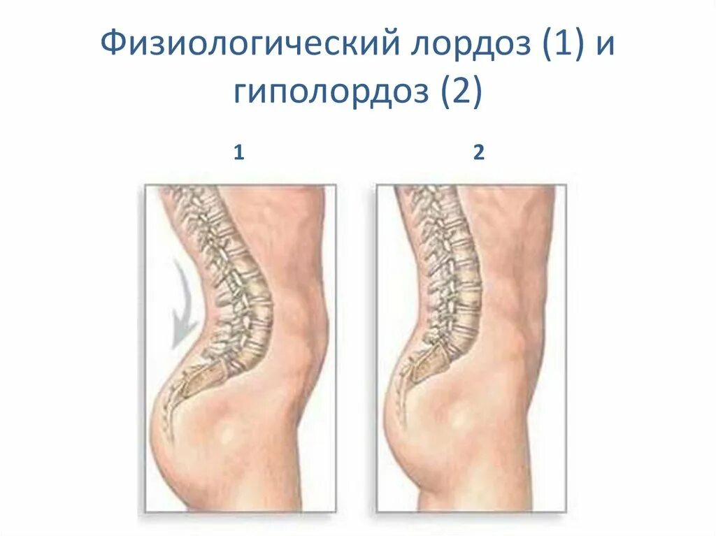 1 лордоз. Искривление позвоночника лордоз. Сколиоз кифоз лордоз шейного отдела. Искривление грудного отдела позвоночника кифоз. 1 лордоз.