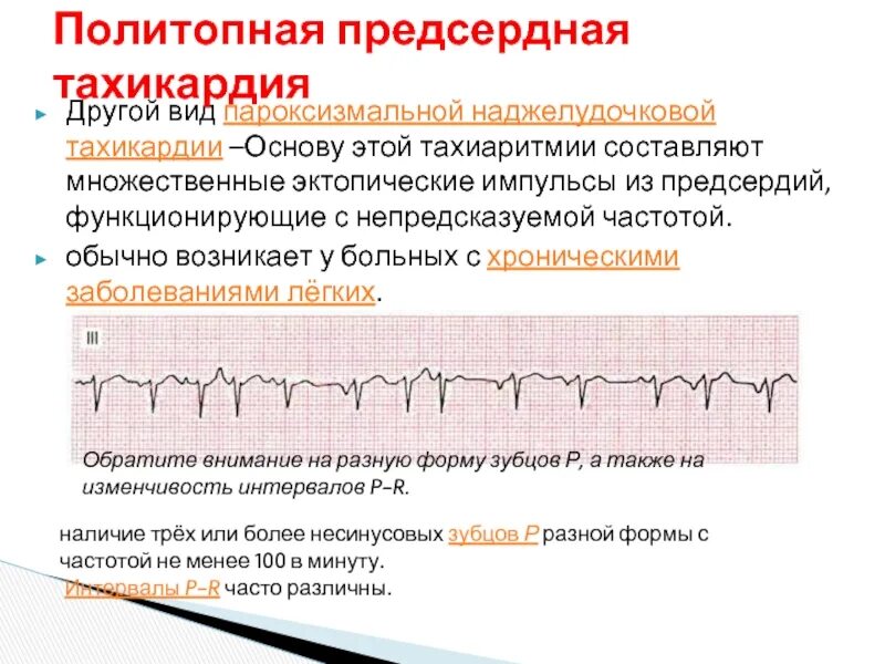 Пробежка тахикардии. Желудочковые экстрасистолы на экг. Фасцикулярная жт фото. Пробежка тахикардии после экстрасистолы. Синусовая тахикардия.