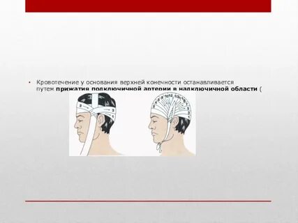 При кровотечении на голове необходимо
