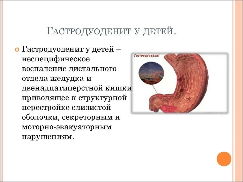 Гастродуоденит что это симптомы. Нодулярный гастродуоденит. хронический гастродуоденит синдромы. гастрит дуоденит гастродуоденит. язвенноподобный гастродуоденит.