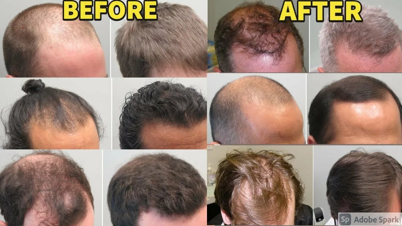 Миноксидил алерана эффект. Миноксидил для головы до и после волос мужчин. Миноксидил для волос для мужчин для головы. Волосы после миноксидила