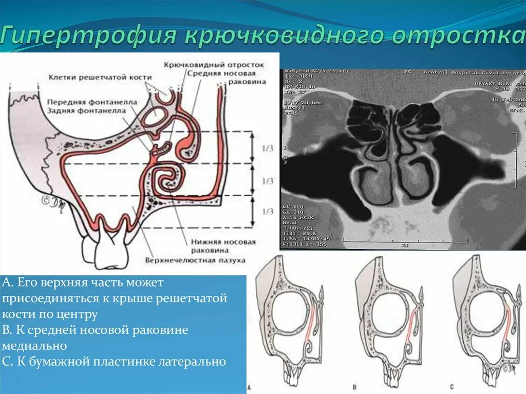 Конха буллеза средних носовых раковин. Аномалии носовых раковин кт. Гипертрофический ринит слизистая. Гипертрофия носовых раковин на кт. Конха буллеза верхней носовой раковины кт.
