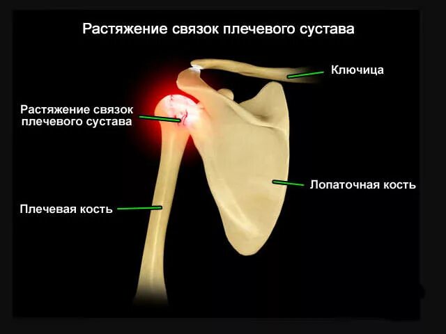 Эффективное лечение плечевого сустава. Повреждение КСА плечевого сустава. Неполный разрыв плечевого сустава. Растяжение капсулярно-связочного аппарата поеча. Надрыв связок плечевого сустава.