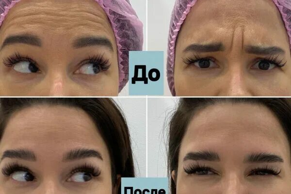 Сколько встает лоб после ботокса. Сколько встает лоб после ботокса. Сколько встает лоб после ботокса. Сколько встает лоб после ботокса. Лоб после ботокса по дням.