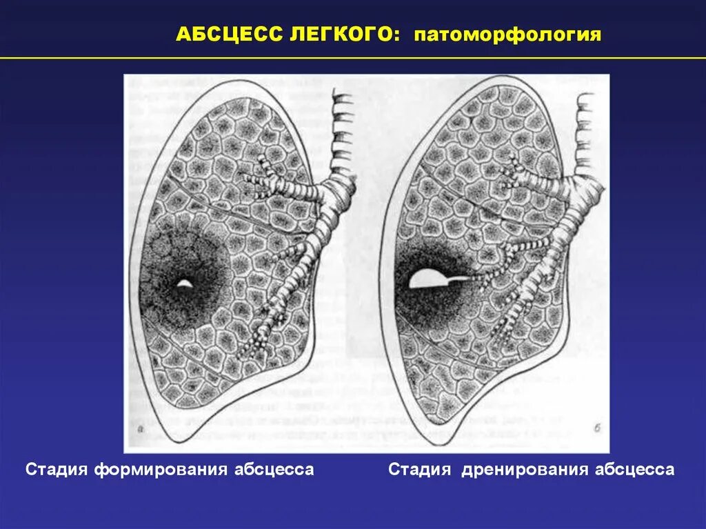 Для абсцесса легкого характерно. Абсцесс легкого патоморфология. Стадии абсцесса легкого. Абсцесс лёгкого стадии. Стадии формирования абсцесса легкого.