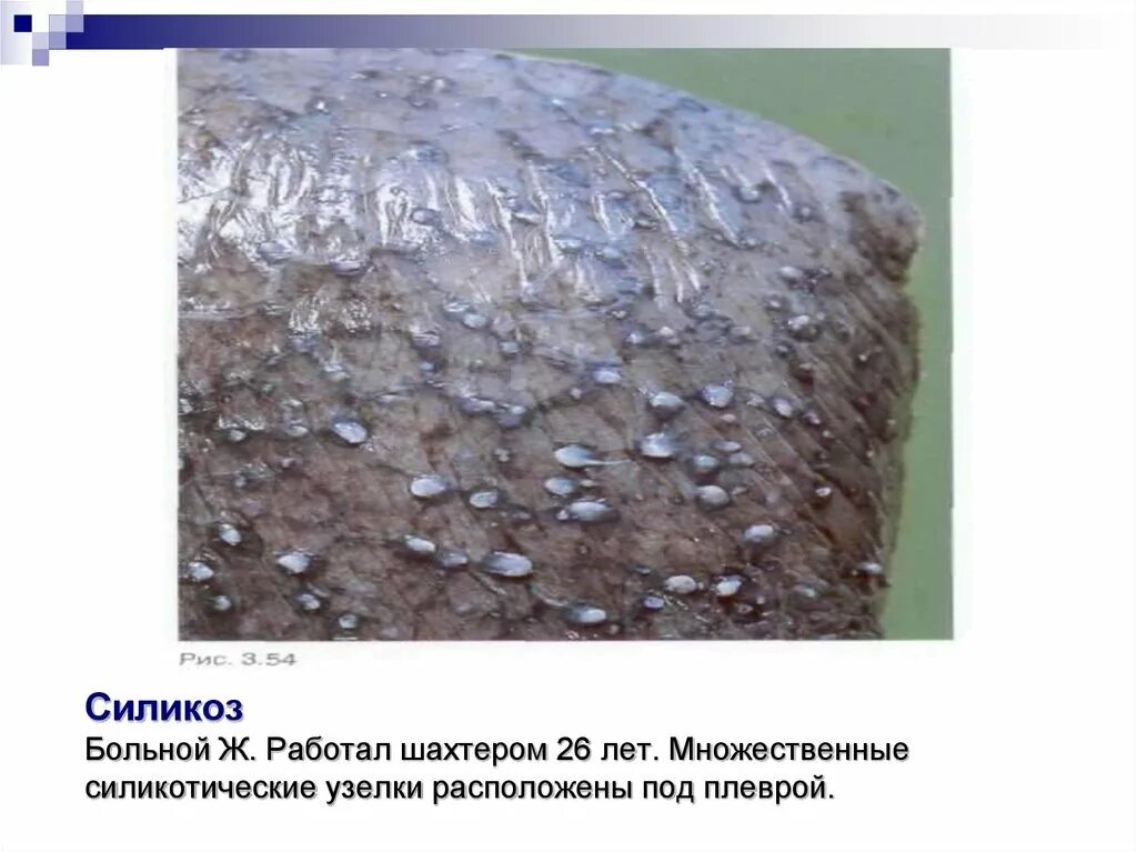 Профессиональные заболевания шахтеров. Профессиональные заболевания шахтеров. Болезни шахтеров профессиональное заболевание. Силикоз макропрепарат. Болезнь легких силикоз.
