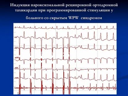 Реципрокная тахикардия