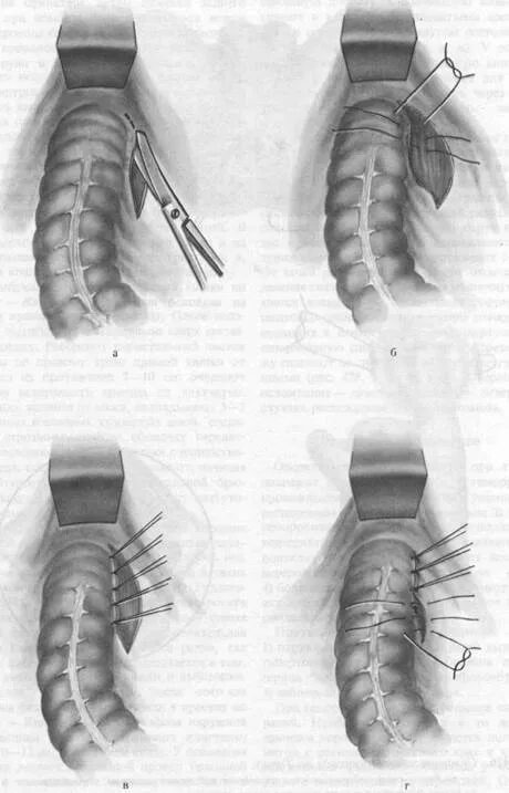 Ревматоидный артрит внчс кт. Спинальный стеноз операция. Сужение просвета пищевода. Инфаркт миокарда окклюзия артерий. Стеноз заднего.