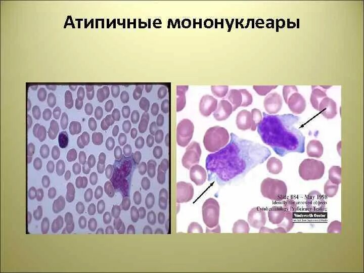 Атипичные мононуклеары