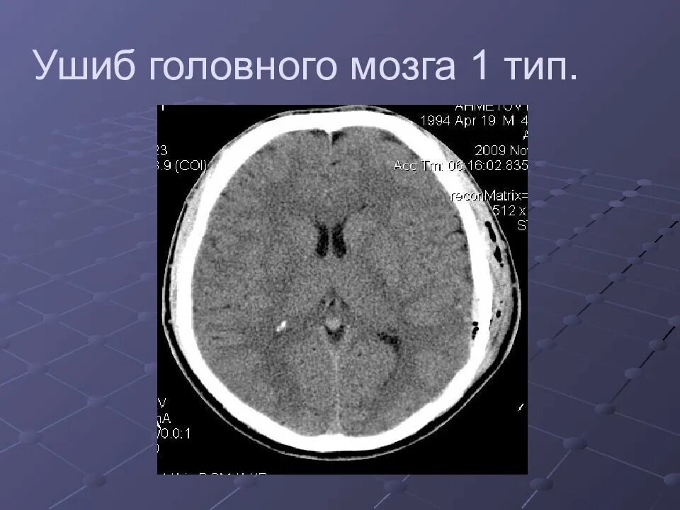 Травматических повреждений мозга. Ушиб головного мозга 1 типа кт. Типы ушибов головного мозга на кт. Контузионные очаги головного мозга 1 типа. Контузионный очаг головного мозга 1 типа на кт.