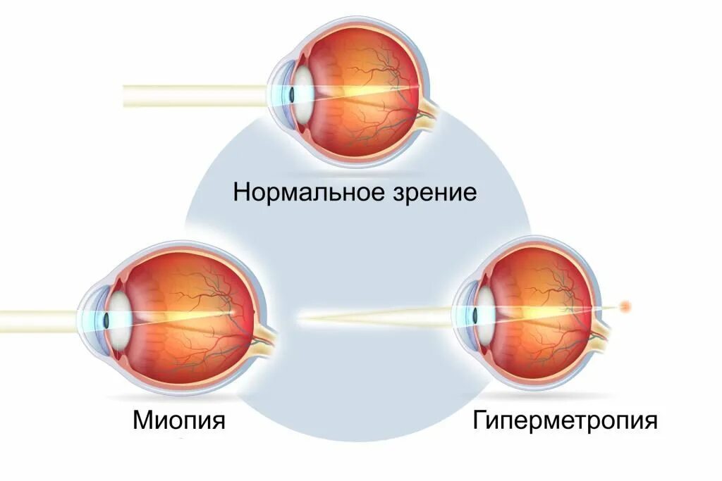 Операция при дальнозоркости. Заболевания глаз близорукость и дальнозоркость. Строение глаза дальнозоркость. Дальнозоркость и близорукость строение глаза. Строение глаза человека близорукость и дальнозоркость.