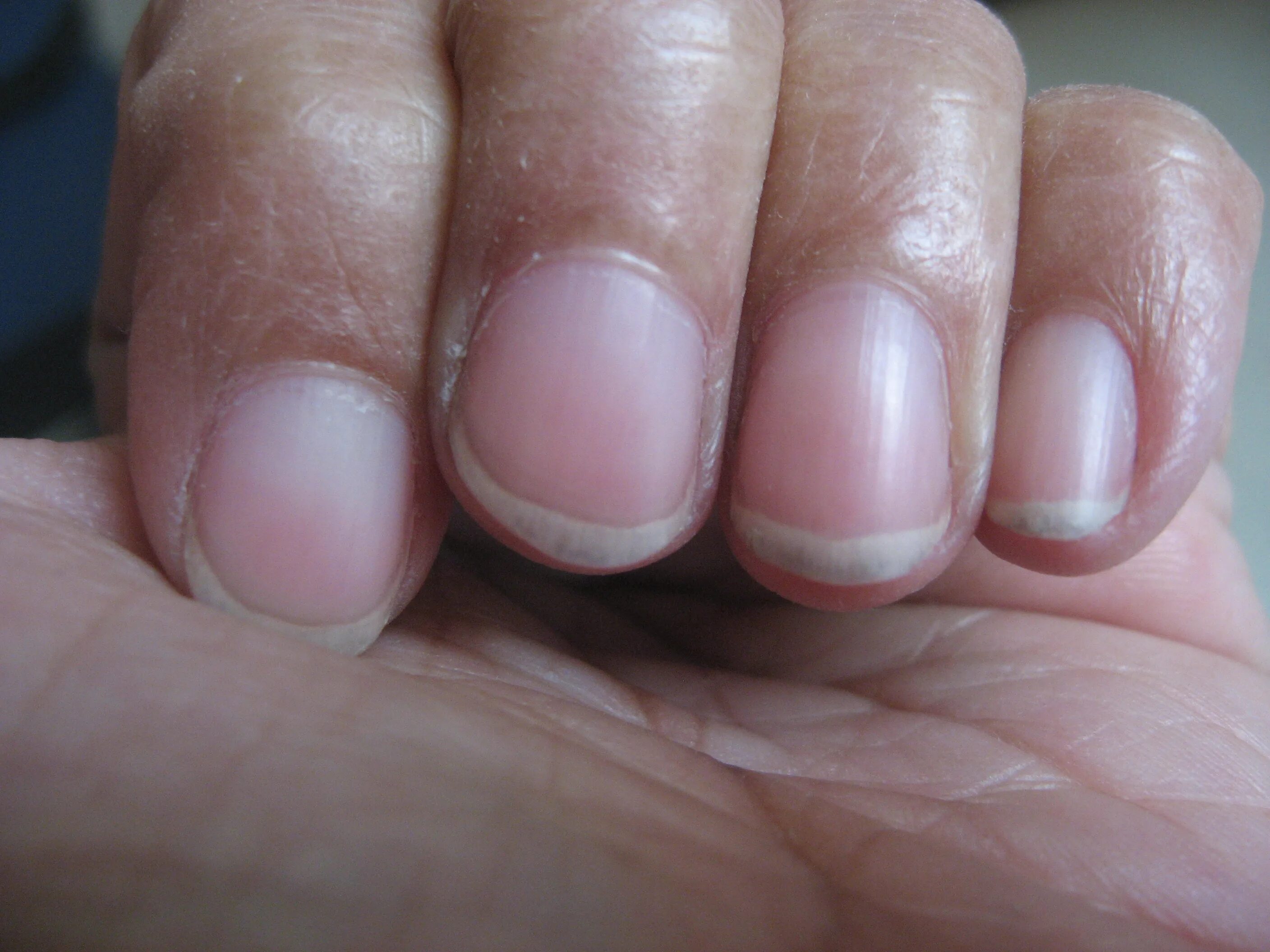 почему ногти квадратные