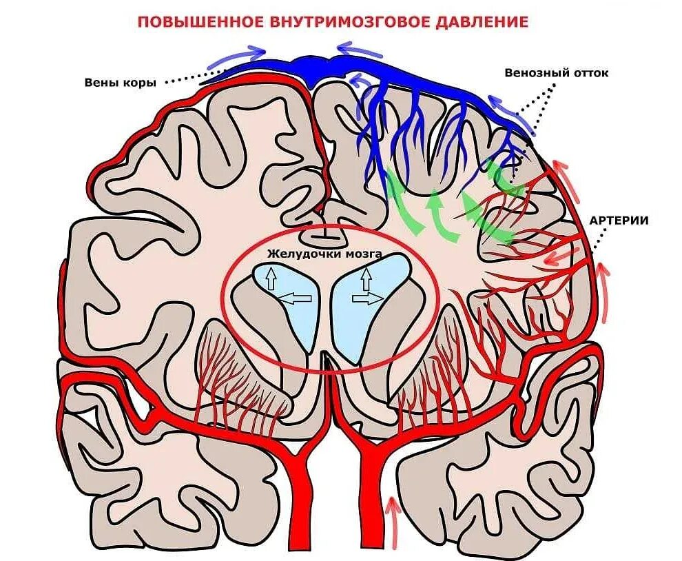 Отток головного мозга. Гипертензия головного мозга. Внутричерепное мозговое давление. Артериальная гипертензия и головной мозг. Головной мозг при гипертонии.