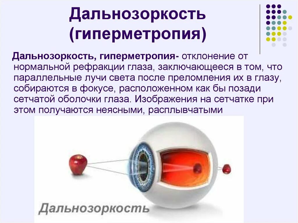 Гиперметропия высокой степени рефракция. Заболевание дальнозоркость. Дальнозоркость (гиперметропия). Строение глаза человека астигматизм. Заболевание дальнозоркость.