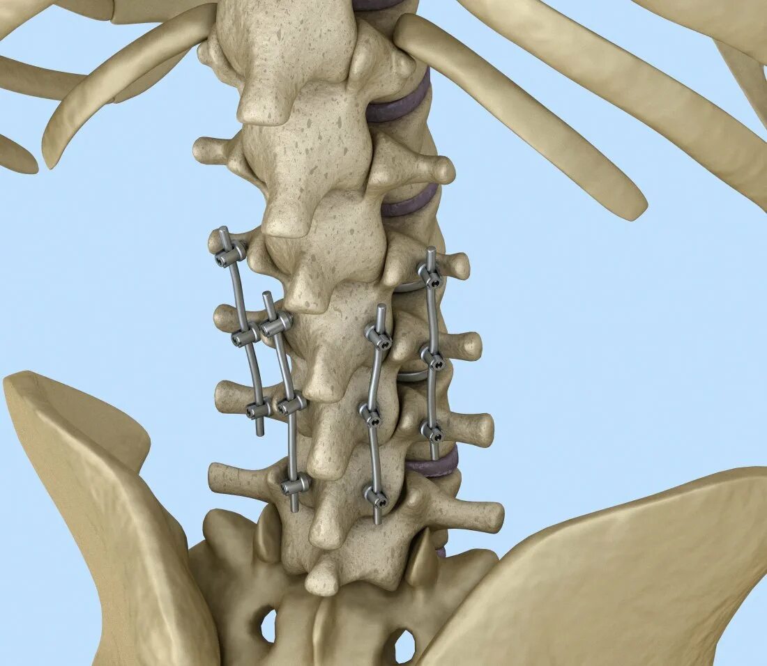 Транспедикулярная фиксация th11 th12- l2 l3. Транспедикулярная фиксация l1-l2-l3-l4-l5 системой. Транспедикулярная фиксация позвоночника l4-l5. Транспедикулярный винт Stryker. Операция фиксация позвоночника