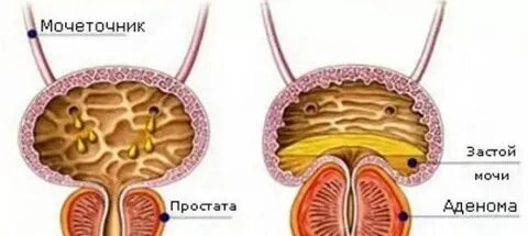 Сок предстательной железы