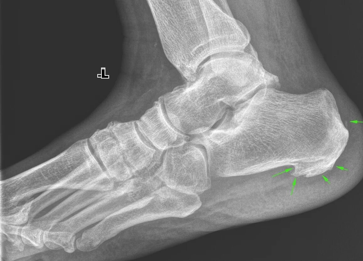 Рентгенагатомия таранной кости. Анатомия таранной кости на рентгене. Остеопороз пяточной кости рентген. Таранная кость стопы рентген.