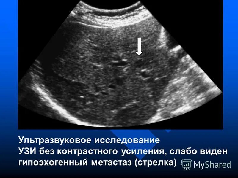 Метастазы в печени узи заключение. Эхограмма печени с метастазами. Метастазы в селезенке на узи. Кистозные метастазы в печени на узи. Эхограмма печени с метастазами.