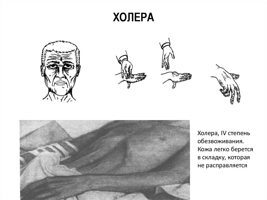Первые симптомы холеры. Холера 4 степень обезвоживания. Клинические симптомы холеры. Клинические проявления легкой формы холеры. Клиника холеры степени обезвоживания.