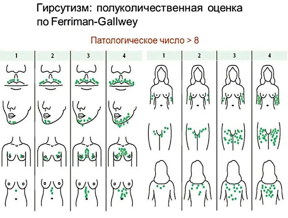 Ферримана Голлвея. Шкала гирсутизма Ферримана Голлвея таблица. Шкала оценки гирсутизма. Оценка гирсутизма по шкале Ферримана-Голлвея. В каком возрасте начинают расти волосы