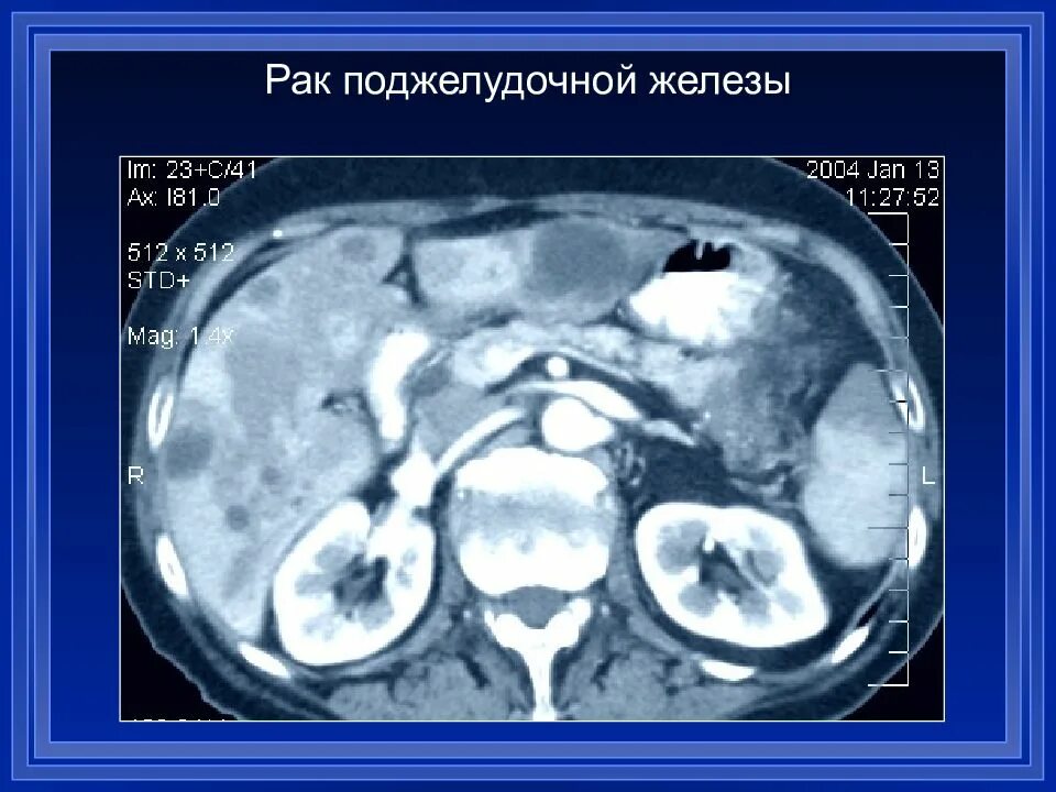 Объемное образование головки поджелудочной железы кт. Опухоль крючковидного отростка поджелудочной железы кт. Опухоль хвоста поджелудочной железы кт. Опухоль поджелудочной железы злокачественная диагностика.