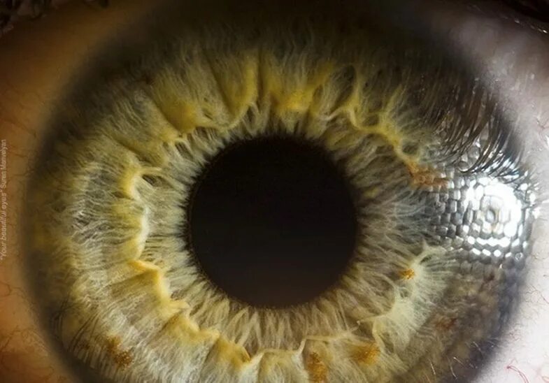 Болотный цвет глаз гетерохромия. Центральная гетерохромия зеленый карий. Сурен манвелян глаза человека. Колобома радужной оболочки. Отпечатки радужке.