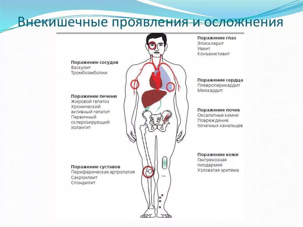 Внекишечные системные проявления язвенного колита. Внекишечные проявления воспалительных заболеваний кишечника. Внекишечные осложнения болезни крона. Проявились последствия. Подострый гломерулонефрит симптомы.