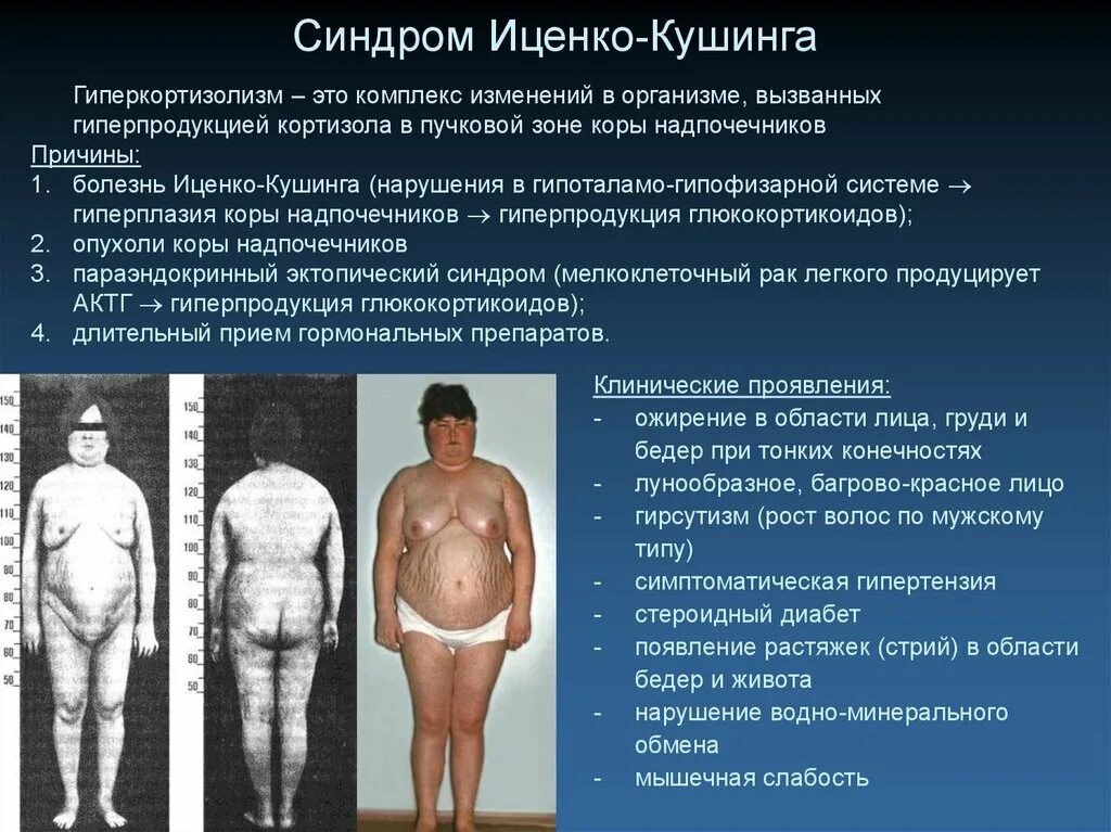 Синдром кушинга препараты. Болезнь иценко -кушинга кортизол. клиническая симптоматика болезнь иценко- кушинга. синдром иценко-кушинга тип ожирения.