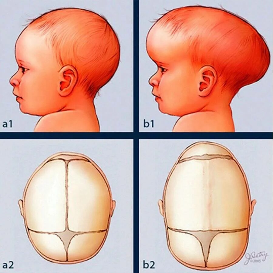 Краниосиностоз скафоцефалия. Голова новорожденного форма скафоцефалия. Краниосиностоз черепных швов. Метопический краниосиностоз тригоноцефалия.