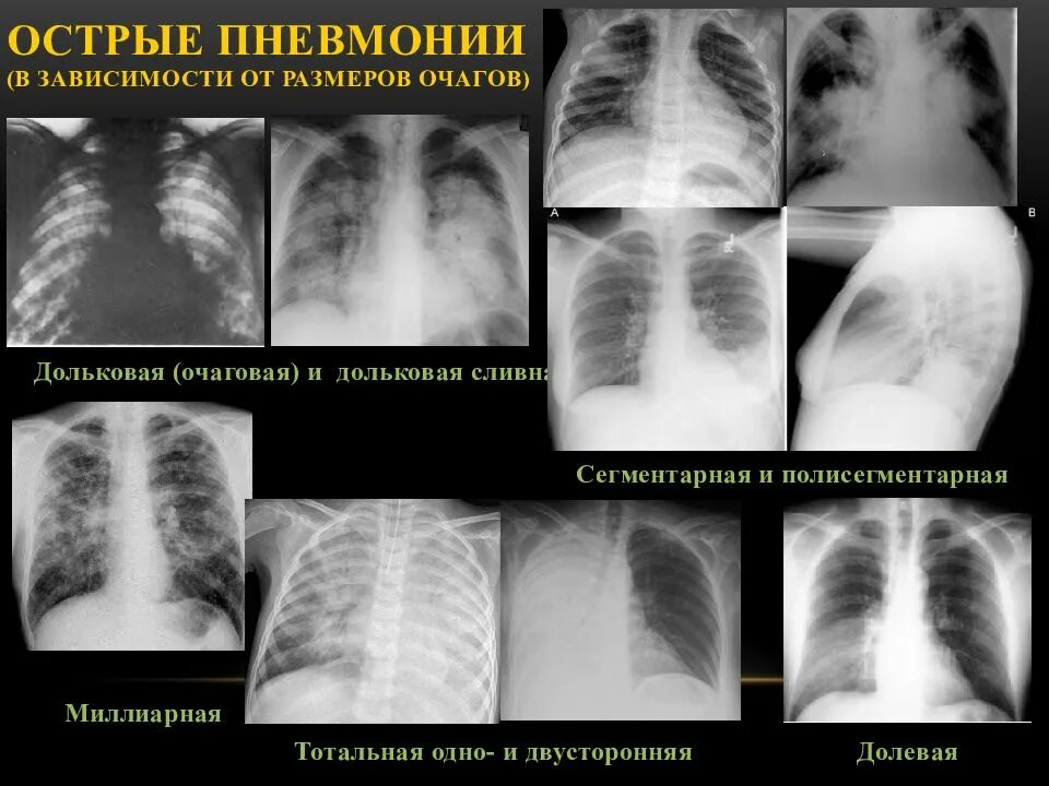 Острая очаговая пневмония рентген. Острая двусторонняя полисегментарная пневмония. Очаговая полисегментарная пневмония. Крупозная и очаговая пневмония. Острое поражение легких