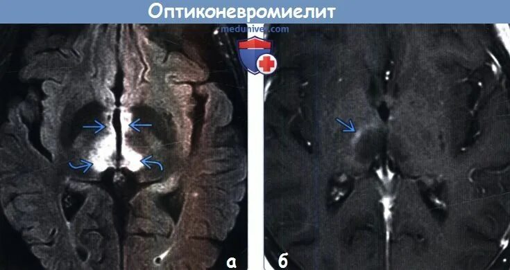 Заболевание спектра оптиконевромиелита. Оптиконевромиелит. Заболевание спектра оптиконевромиелита. Оптиконейромиелит девика. Нейрооптикомиелит девика.