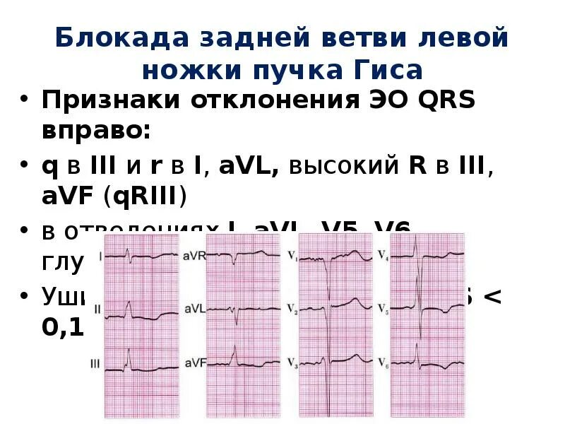 Блокада левой ножки пучка гиса на экг. Неполная блокада передней ветви ЛНПГ на ЭКГ. Неполная блокада левой ножки пучка Гиса. Признаки блокады левой ножки пучка Гиса.