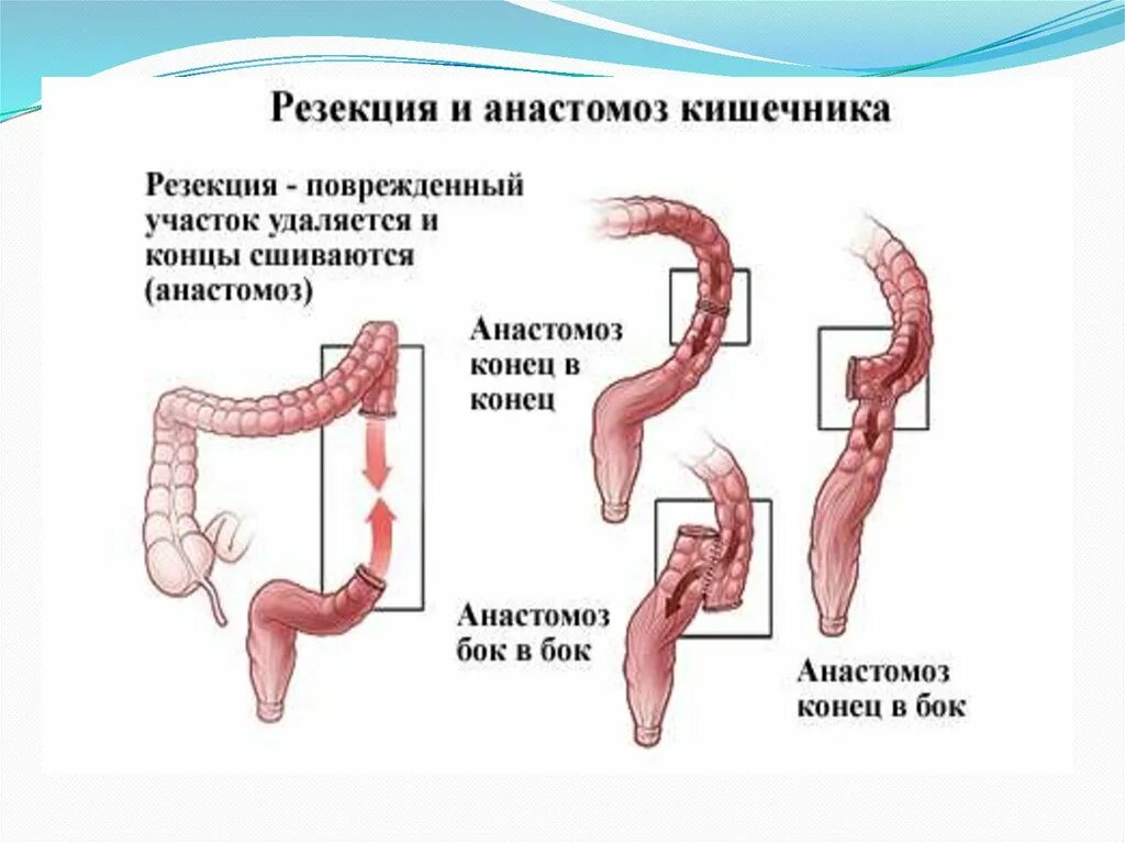 Резекция ободочной и анастомоз. Анастомоз Толстого кишечника. Резекция толстой кишки с анастомозом. Аппаратный анастомоз сигмовидной кишки.