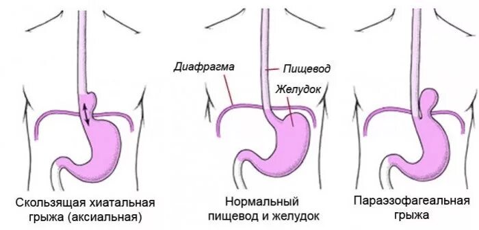 Аксиальная грыжа пищеводного отверстия диафрагмы симптомы. Грыжа пищевого отверстия симптомы. Грыжа пищевого отдела диафрагмы. ГПОД скользящая степени.