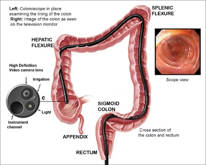 Колоноскоп используется. Колоноскопия прямой и толстой кишки. Ободочная кишка эндоскопия. Эндоскопическое исследование Толстого кишечника кишки. Колоноскопия Толстого кишечника.