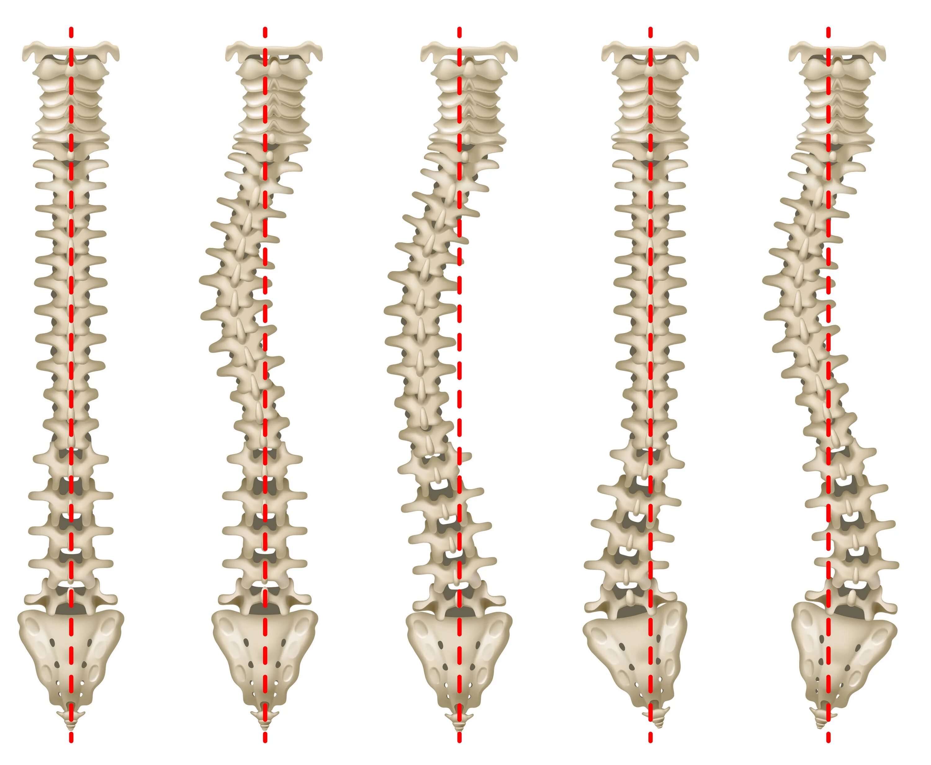 Сколиоз поясничного отдела 4 степени. Сколиоз грудного отдела позвоночника 1ст. Сколиоз позвоночника 1 степени. Сколиоз грудного отдела позвоночника 1 степени.