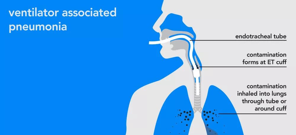 Ventilator-associated pneumonia (Vap). Ventilator-associated (Vap). Pneumonia Osmosis. MDI:Ventilation. Vap tpu ru