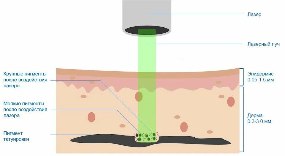В собственно коже отсутствует пигмент. Введение пигмента в кожу. Глубина введения пигмента в кожу. Внедрение пигмента в кожу. Воздействие неодимового лазера на кожу.