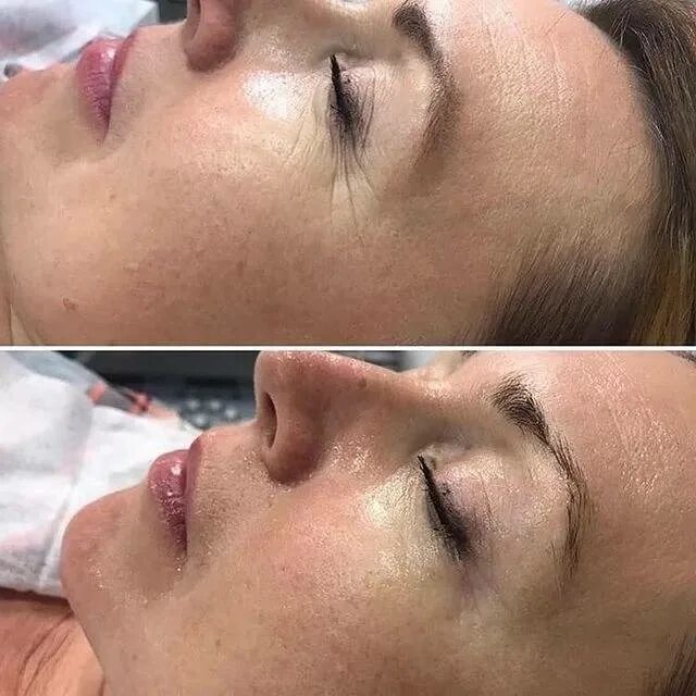 Пилинг карбокситерапия до после. Карбокси пилинг. Карбокситерапия со2 oxigeneo. Карбокситерапия безинъекционная. Косметологические процедуры.