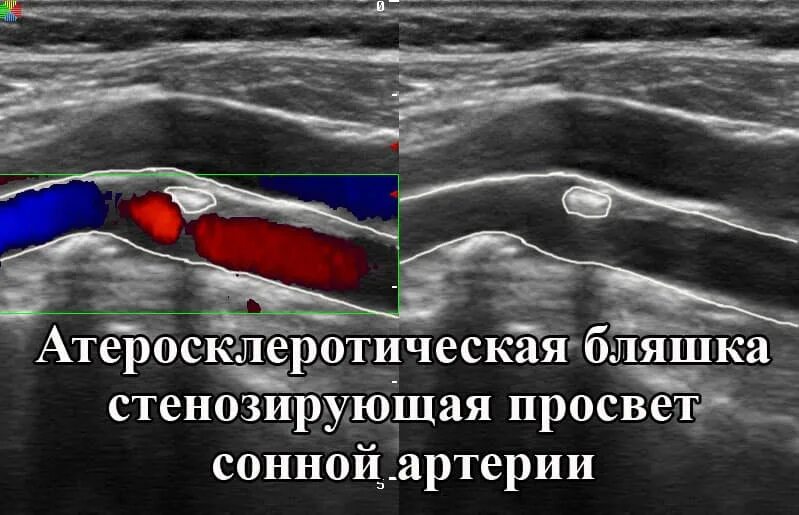 Нестенозирующий атеросклероз бца что это. Атеросклероз сосудов шеи УЗИ. Стеноз сонных артерий на УЗИ. Атеросклероз сонных артерий УЗИ. Стеноз внутренней сонной артерии УЗДГ.